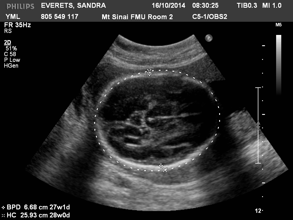 most accurate ultrasound for due date