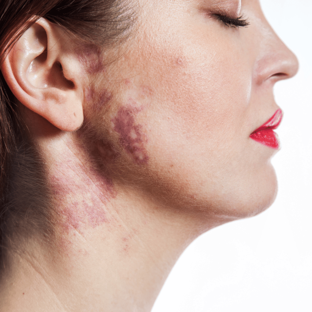 Birthmarks: The Different Kinds and When to Call the Doctor